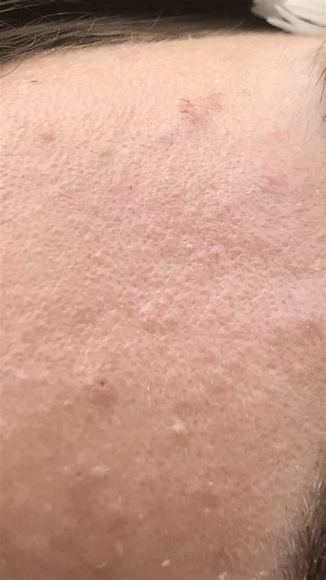[skin concern] Why this texture suddenly appeared on my forehead and ...