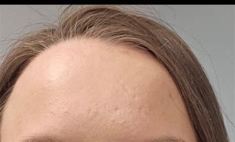 Forehead acne scars : r/AcneScars