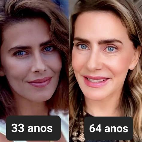 Botox Abaixo Dos Olhos Antes E Depois - Botox: Antes e depois em 20 Fotos – Antes da Fama