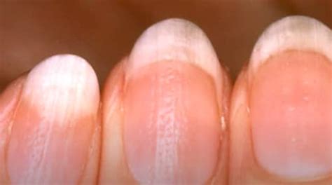 Nail Pitting: Causes, Treatment, and More - IYTmed.com