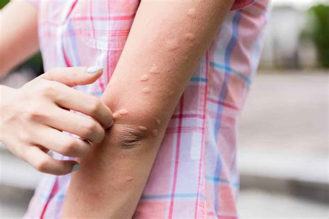 Best Guide To Relieve Mosquito Bites With Mosquito Treatment