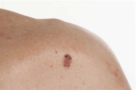 Basal Cell Carcinoma Causes Clear Skin Clinic