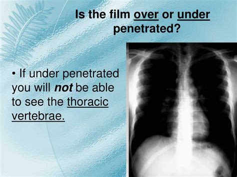PPT - Comprehensive Guide to Basic Chest X-Ray and Arterial Blood Gas