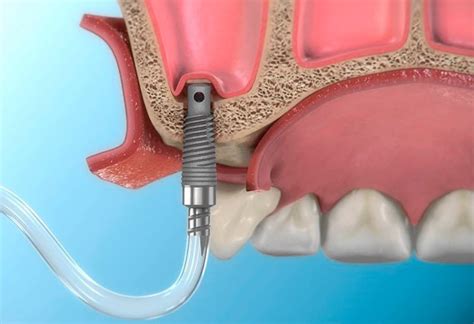 Что такое синус-лифтинг? | Стоматология Denta