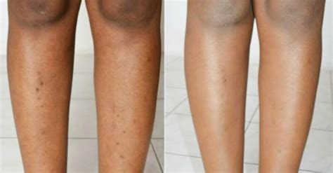 Linha Nigra Na Perna - Angiodermite Pigmentar Manchas Escuras Na Perna - RETOEDU