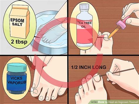 how long does it take an ingrown toenail to heal