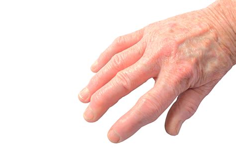 Psoriatic Arthritis Causes and Symptoms - University Health News