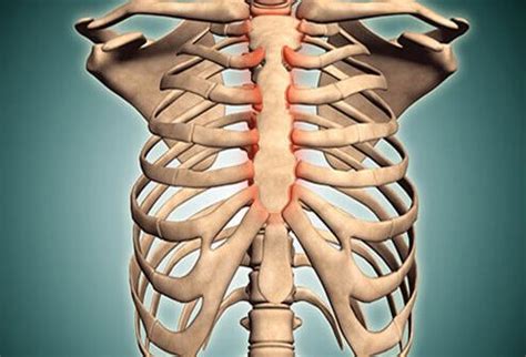 costochondritis pain locations  treatment symptoms recovery time