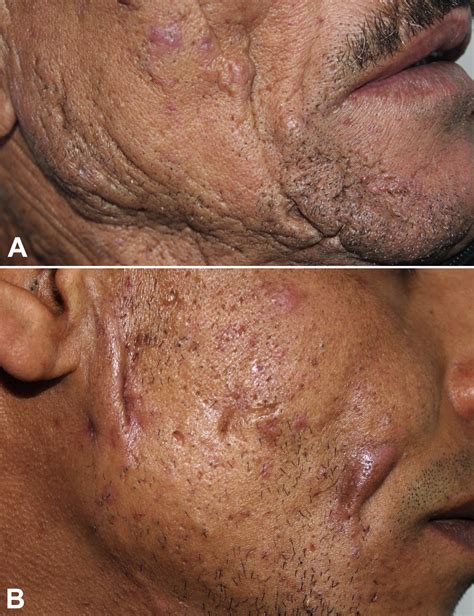 facial hidradenitis suppurativa  potential mimicker  acne vulgaris