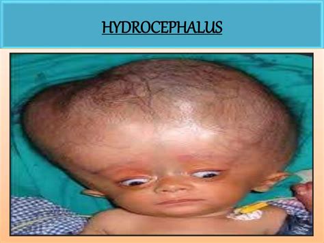 hydrocephalus-180822081453.pdf