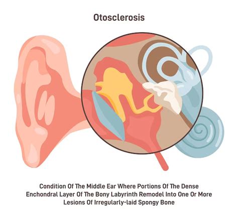 Otosclerosis Histology