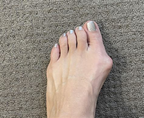 2 weeks Post Op w/pics : r/bunions