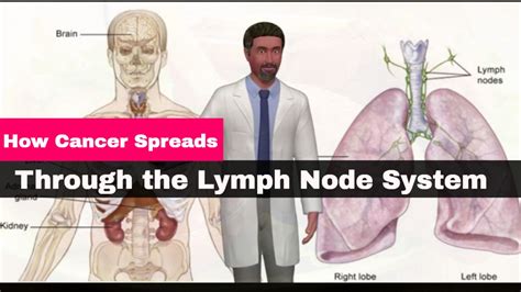 How Cancer Spreads Through The Lymph Node System - Male Health Clinic