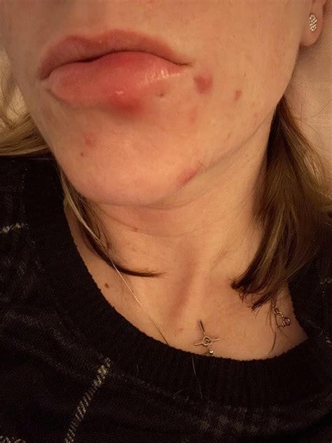 Swollen lip : r/DermatologyQuestions