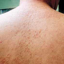 papular skin lesions   tendency  focus   arm rycina