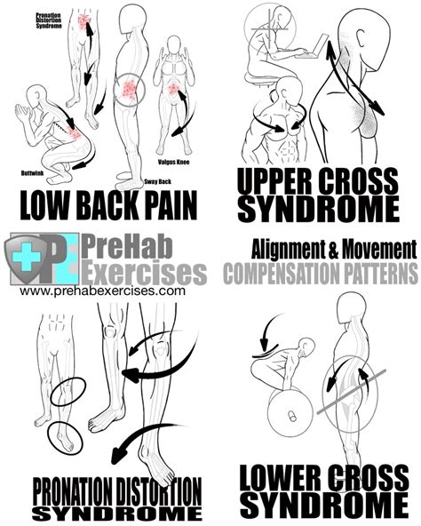 PreHab Exercises List of Common Compensation Patterns for Alignment and ...