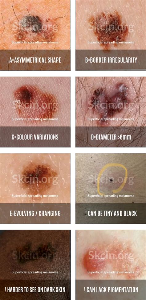 melanoma skin cancer