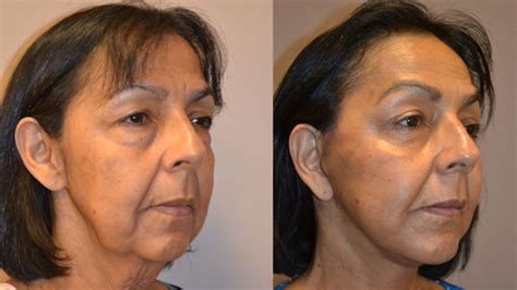 Is the Mini Lift or Mini Facelift Cost Really a Bargain? - LookYounger.News