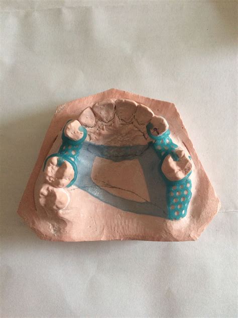 Reciprocation In Removable Partial Denture Design at Tracy Sudie blog