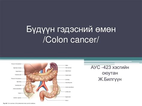 Бүдүүн гэдэсний хорт хавдар