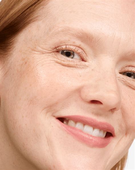 blackheads along lip line 8