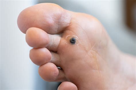 Plantar Warts: Understanding the Causes & Removal Techniques