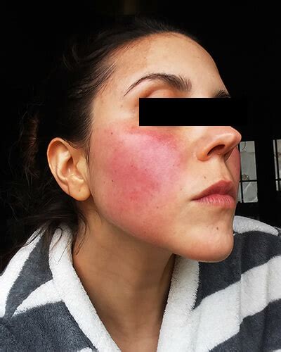 rosacea  cheeks