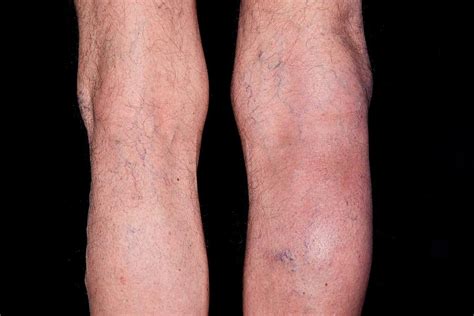 Ruptured Baker's Cyst Photograph by Dr P. Marazzi/science Photo Library