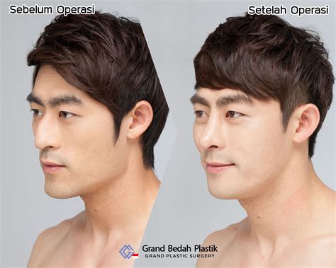 31 crazy before and after photos of korean plastic surgery – Artofit