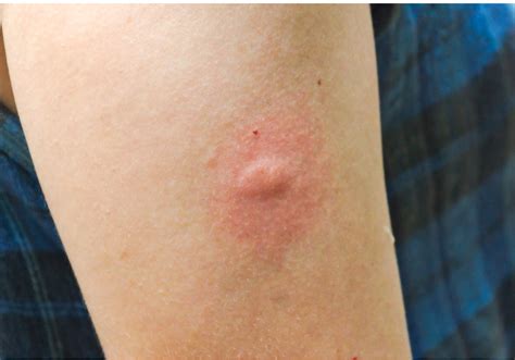 infected insect bites treatment letchworth pharmacy