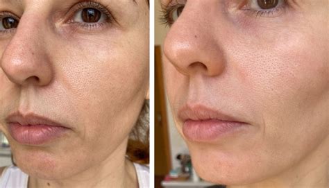 Bisyou Preenchedor Antes E Depois - Bisyou Preenchedor Facial ANTES e DEPOIS - resenha em pele madura