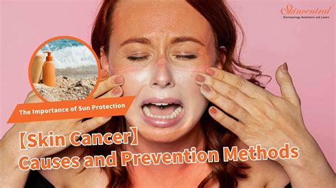 【Skin Cancer】Causes and Prevention Methods | The Importance of Sun ...