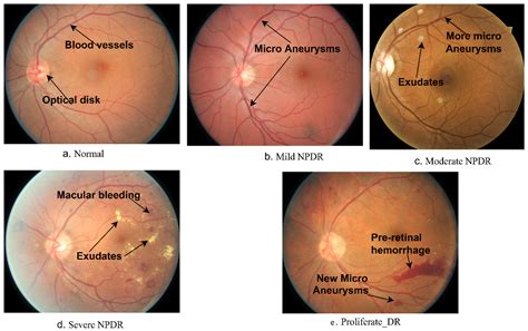 diabetic retinopathy staging guide xfwkz