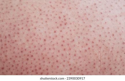 keratosis pilaris harmless skin condition  stock photo