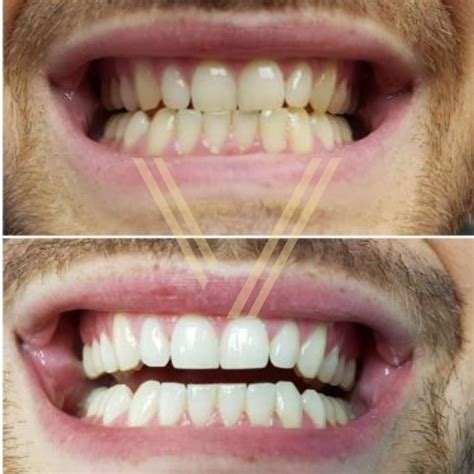 Teeth Whitening in Istanbul Turkey - Costs in 2025