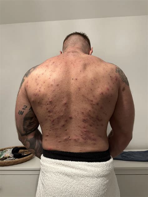 Bacne from steroids : r/trt