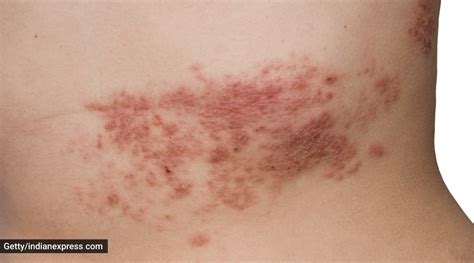 Is developing shingles, a painful rash, common after Covid vaccines ...