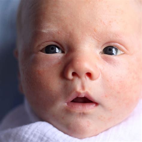 My Newborn Has White Bumps On His Face - Infoupdate.org