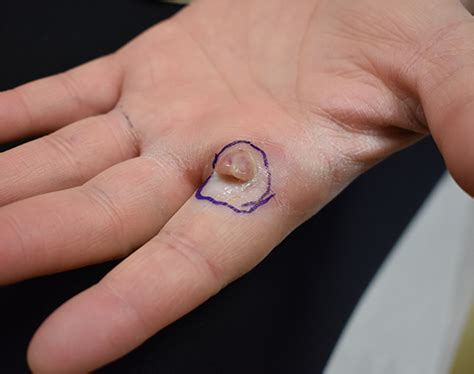 pyogenic granuloma lobular capillary hemangioma school  medicine