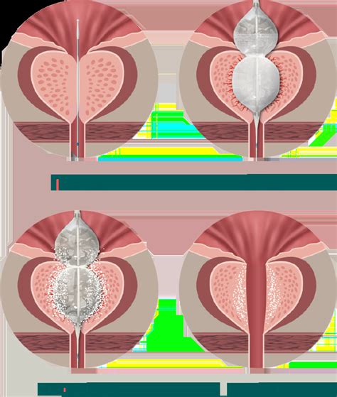 benign prostatic hyperplasia bph laborie