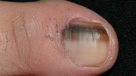 Black Spot Under Toenail Melanoma - Bios Pics