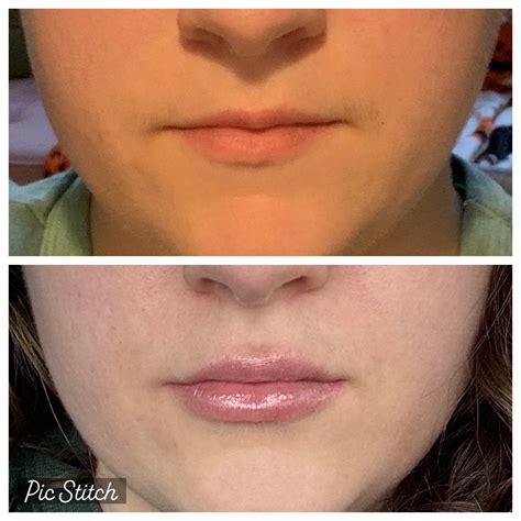 Update on my lip fillers now that all the swelling is settled—still