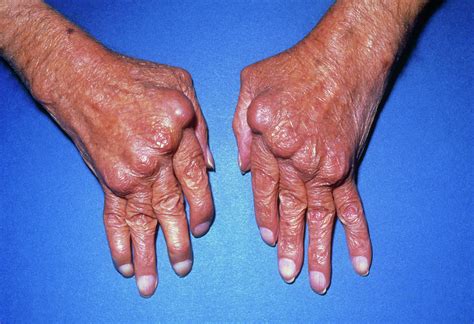 Rheumatoid Arthritis Manifestations