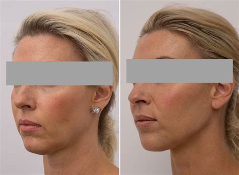 Jowl Treatment Melbourne | Treatment Areas | Face to Face Medical