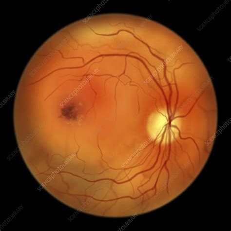 Best vitelliform macular dystrophy, illustration - Stock Image - F037 ...
