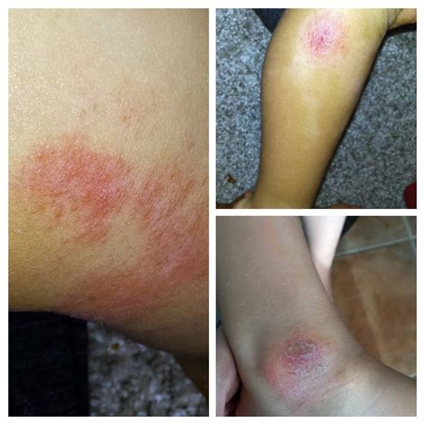 How to prevent eczema flare ups, 5 steps - AtMyTable