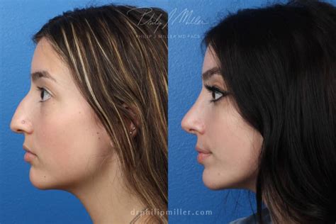 choose  nose tip surgery  full rhinoplasty philip