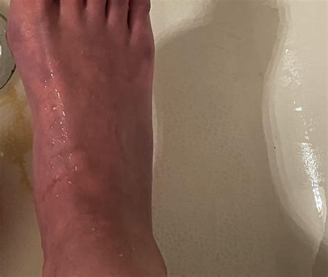 Have you had discoloration after leg/ankle fracture? : r/brokenbones