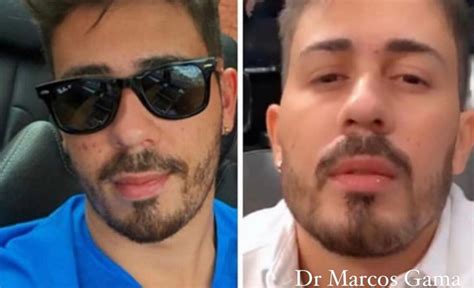 Carlinhos Maia Antes E Depois - Foto: Carlinhos Maia antes e depois da harmonização facial - Purepeople