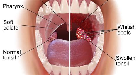 Tonsils: Facts, Function & Treatment – My Vue News